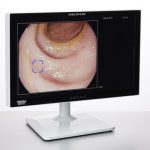HOYA Group PENTAX Medical Cleared CE Mark for DISCOVERY(TM), an AI Assisted Polyp Detector