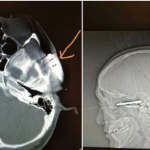 Arrow pierces student’s face during archery training