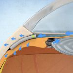 First truly biocompatible MIGS implant from iSTAR Medical shows consistently outstanding efficacy in patients with glaucoma
