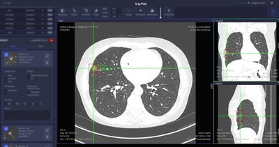 Product screenshot of VUNO Med®-LungCT AI™ Product screenshot of VUNO Med®-LungCT AI™