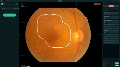 Product Screenshot of VUNO Med®-Fundus AI™