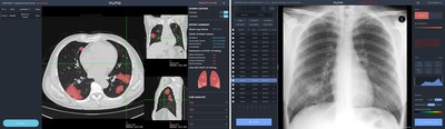 VUNO Med®- LungQuant™ and VUNO Med®-Chest X-ray™: COVID-19 ver. VUNO Med®- LungQuant™ and VUNO Med®-Chest X-ray™: COVID-19 ver.