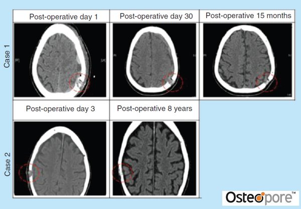 Post-surgery CT scans of two patients at various stages of the Osteoplug implantation recovery — in both cases, tissue ingrowth is observed to cover the burr hole sufficiently