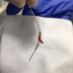 Rapid Medical Receives CE Mark for TIGERTRIEVER(TM) XL
