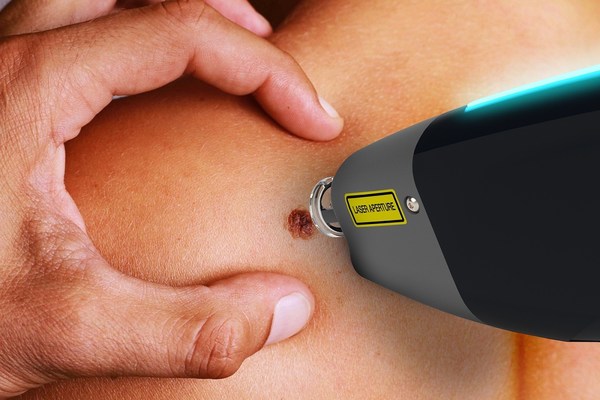 Spectra-Scope is a lightweight, portable device that detects the biochemical information of skin tissue using laser-induced plasma spectroscopy (LIPS). Spectra-Scope is a lightweight, portable device that detects the biochemical information of skin tissue using laser-induced plasma spectroscopy (LIPS).
