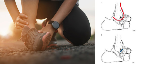 1cm “Lasso” Technique for Ankle Ligament Re-construction, Co-developed by Dr James Wee from Oxford Orthopaedics