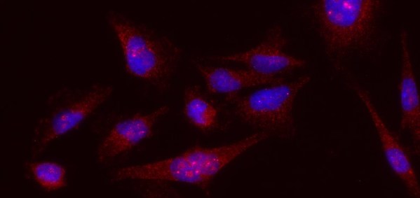 Figure 1. Melanoma cells stained with the BAK1 (red) and Dapi (blue). Figure 1. Melanoma cells stained with the BAK1 (red) and Dapi (blue).