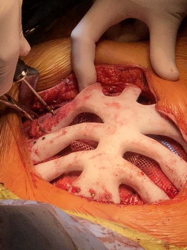 StarPore ribcage being fixed into position with screws. StarPore ribcage being fixed into position with screws.