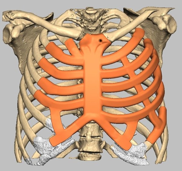 Massive ribcage reconstruction planned with AnatomicsRx C3D software. Massive ribcage reconstruction planned with AnatomicsRx C3D software.