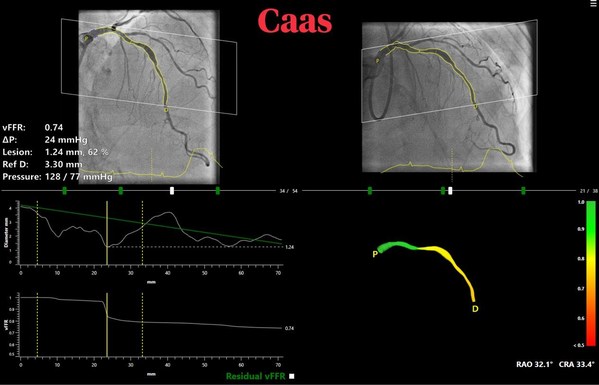 CAAS vFFR for real-time in cathlab non-invasive calculation of lesion significance