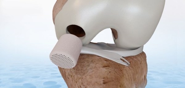 FDA approves CartiHeal’s Implant for the Treatment of Cartilage and Osteochondral Defects