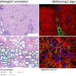 HistoIndex and Global Liver Experts Advance Stain-free AI Quantification of Hepatocyte Ballooning as a Reproducible Approach and Potential Endpoint for NASH Clinical Trials