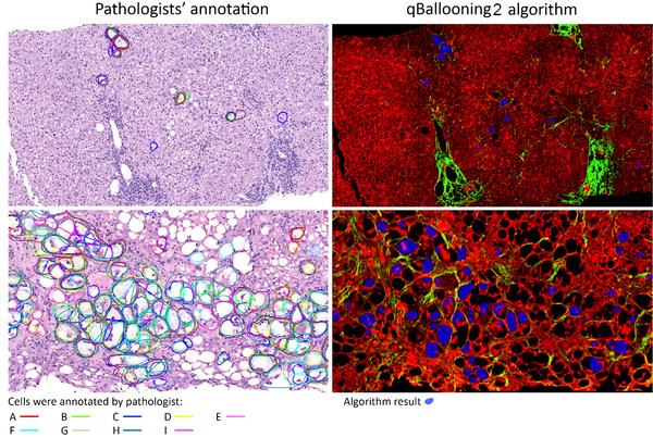 Two examples showing the identification of hepatocyte ballooning by pathologists (left) and qBallooning2 (right). The AI algorithm reading, from a separate drug trial, showing agreement with the study pathologist’s interpretation1. Picture Credits: The Complexity of Ballooned Hepatocyte (BH) Identification: Time to Rethink Trial Endpoints for Nonalcoholic Steatohepatitis? by Elizabeth M Brunt, Quentin Anstee, Dean Tai, et. al. Poster presentation, The Liver Meeting (AASLD) 2021.