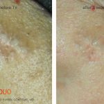 ilooda’s Medical Device Wins FDA Approval for Treating Scars After Monkeypox