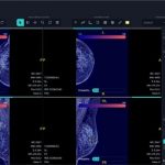 Breast Cancer AI Company FathomX Raises SGD$ 2.24 million in Pre-series A Funding