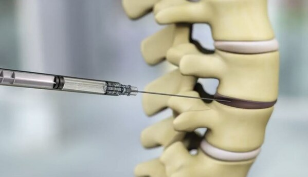 During treatment, a single dose of IDCT is injected into the painful disc percutaneously.