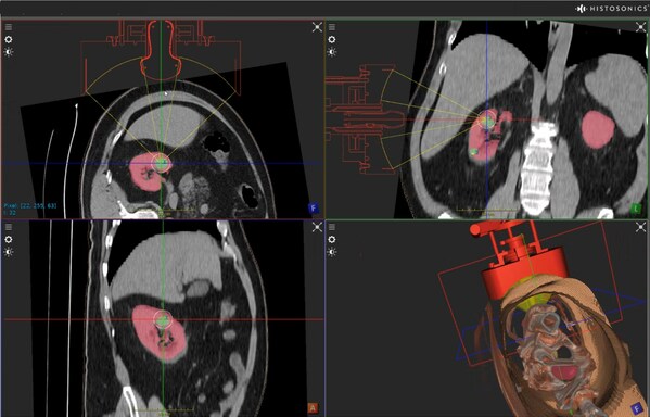 Example of HistoSonics technology targeting kidney tissue to be destroyed in a non-invasive histotripsy procedure. Example of HistoSonics technology targeting kidney tissue to be destroyed in a non-invasive histotripsy procedure.