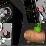 HistoSonics Announces First Ever Kidney Tumor Treatment Using Histotripsy
