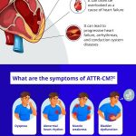 PFIZER CALLS FOR MORE AWARENESS OF TRANSTHYRETIN AMYLOID CARDIOMYOPATHY (ATTR-CM) – A RARE, LIFE-THREATENING DISEASE