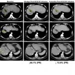 ISCT 2023: Late-breaking SCG101 Data Show 100% HBsAg+ Hepatocyte Eradication and 74.5% HCC Tumour Reduction With Single Dose HBsAg-specific TCR-T Cell Therapy