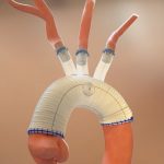 Aquedeon Medical, Inc. Receives FDA IDE Approval for the Duett Vascular Graft System