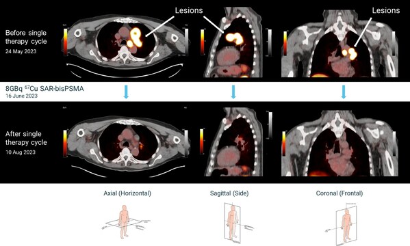 Cu-64 SAR-bisPSMA PET/CT imaging before and after a single cycle of 8GBq Cu-67 SAR-bisPSMA (cohort 2)