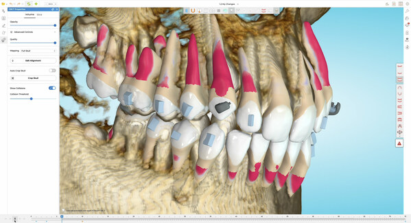 TruRoot™ CBCT Collision Alert System predicts and prevents collisions during treatment to help doctors plan treatments with more precautions. This feature automatically detects and highlights areas on the root surfaces that are touching or penetrating cortical bone. TruRoot™ CBCT Collision Alert System predicts and prevents collisions during treatment to help doctors plan treatments with more precautions. This feature automatically detects and highlights areas on the root surfaces that are touching or penetrating cortical bone.