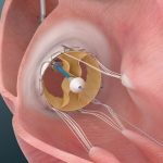 Trisol announces successful implants of its Transcatheter Tricuspid Valve in the US