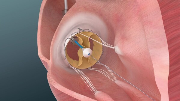 An illustration depicting Trisol valve deployment. An illustration depicting Trisol valve deployment.