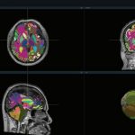 VUNO Secures FDA 510(k) Clearance for VUNO Med®-DeepBrain®