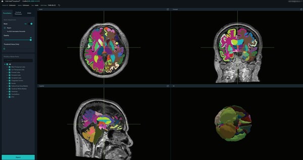 VUNO Med-DeepBrain® UI