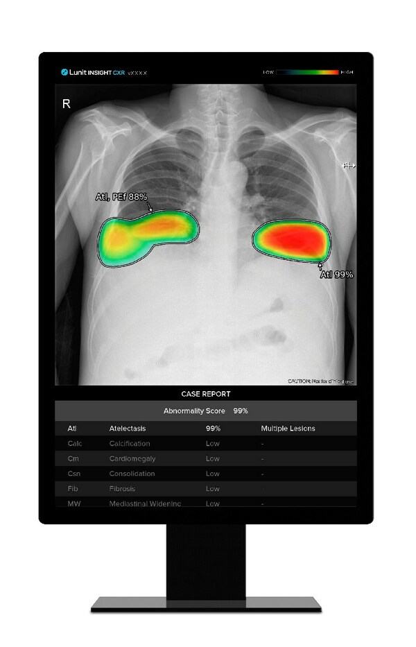Lunit's AI-powered chest X-ray analysis solution, "Lunit INSIGHT CXR" Lunit's AI-powered chest X-ray analysis solution, "Lunit INSIGHT CXR"