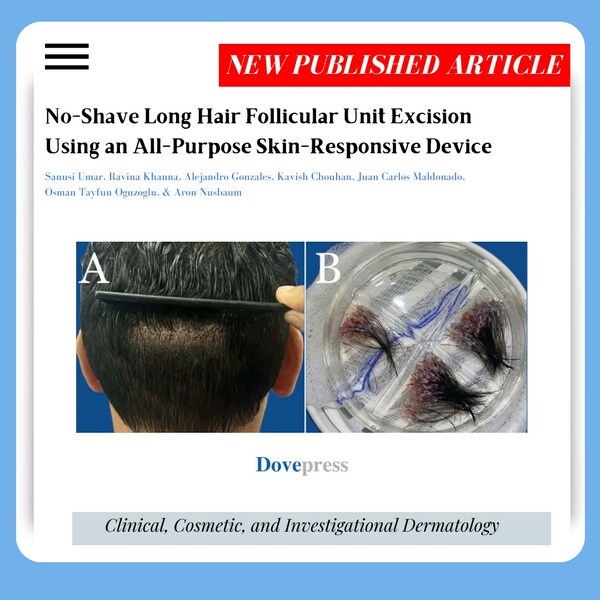 Donor area is shown soon after long-hair FUE using the UGraft Zeus (A). Long-shafted grafts from a straight-haired individual (B). Donor area is shown soon after long-hair FUE using the UGraft Zeus (A). Long-shafted grafts from a straight-haired individual (B).