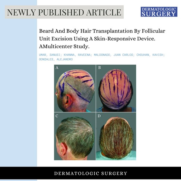 The severely bald patient achieved complete hair restoration utilizing body hair extracted by the UGraft Zeus. The severely bald patient achieved complete hair restoration utilizing body hair extracted by the UGraft Zeus.