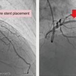 Innovating “Treadmill Exercise Test AI-Assisted Interpretation System,” CMUH(Taiwan) Timely Saves More Patients with Severe Myocardial Infarction