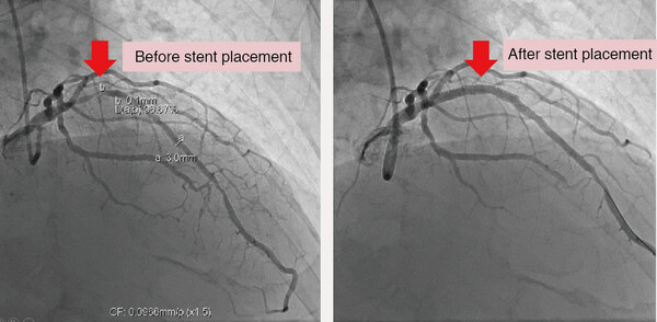 Treadmill Exercise Test AI-Assisted Interpretation System indicated that Mr. Chen had 72% risk of significant coronary artery stenosis. His coronary angiogram showed 99% stenosis in the left anterior descending branch. With percutaneous coronary intervention and stent deployment, he recovered well.