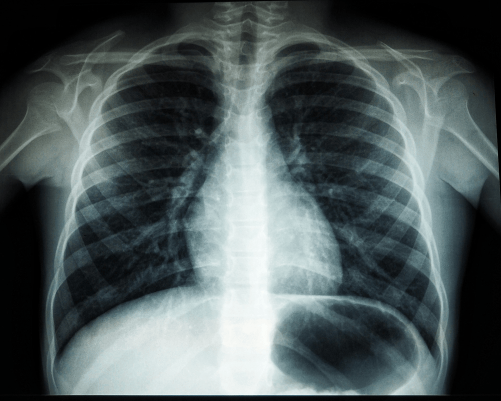 Don’t panic: Prolonged coughs could signal TB, get screened, public urged