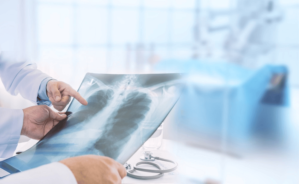 Expert: Targeted TB screening works better than mandatory nationwide screening amid rise in cases